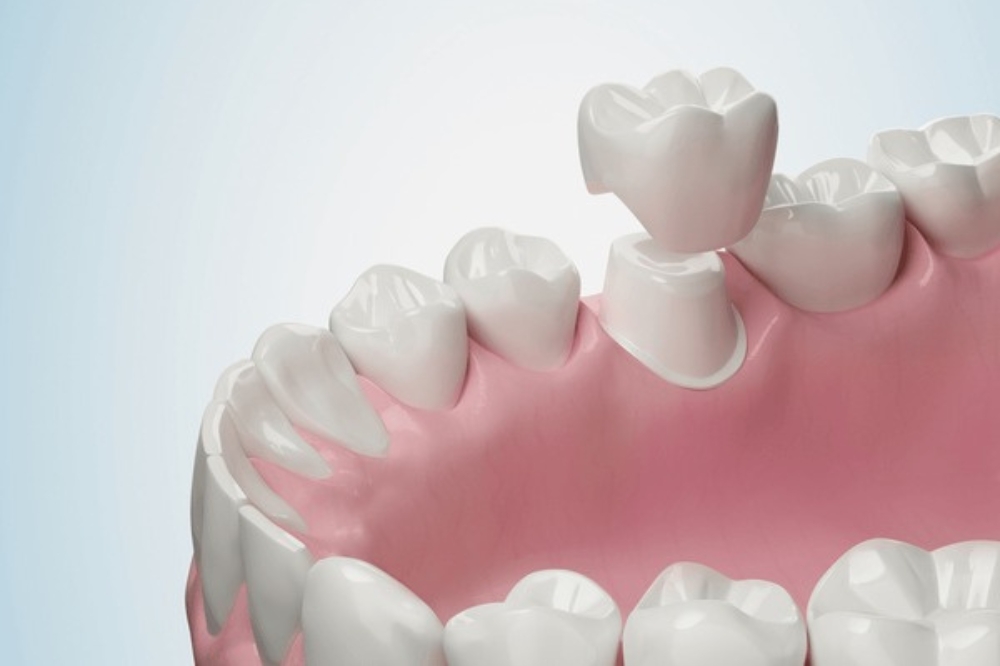 Caring for Dental Crowns: Daily Habits That Prevent Damage