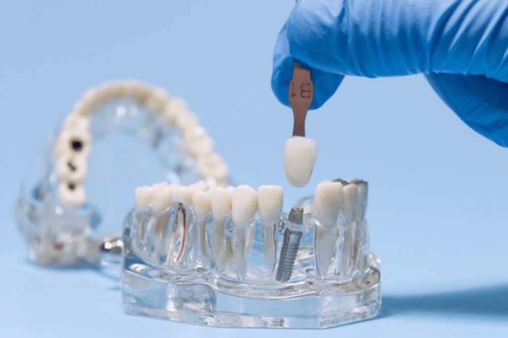 How Long Does the Dental Implant Process Take From Start to Finish