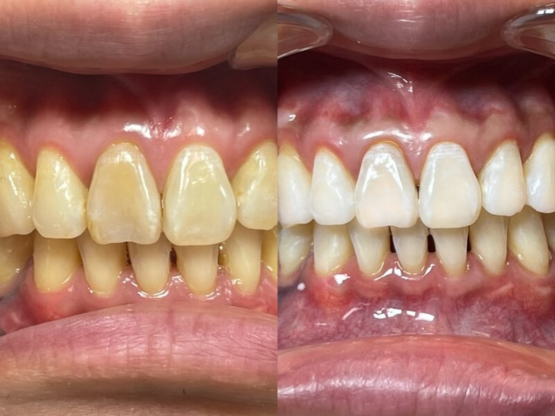 Patient before and after ZOOM whitening