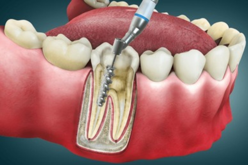 Root Canal Treatment Explained: How Dentists Save Infected Teeth