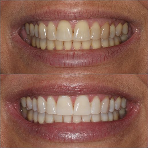 Before and after teeth whitening result
