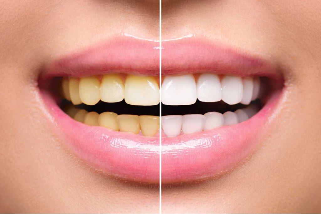 Before and after teeth whitening result