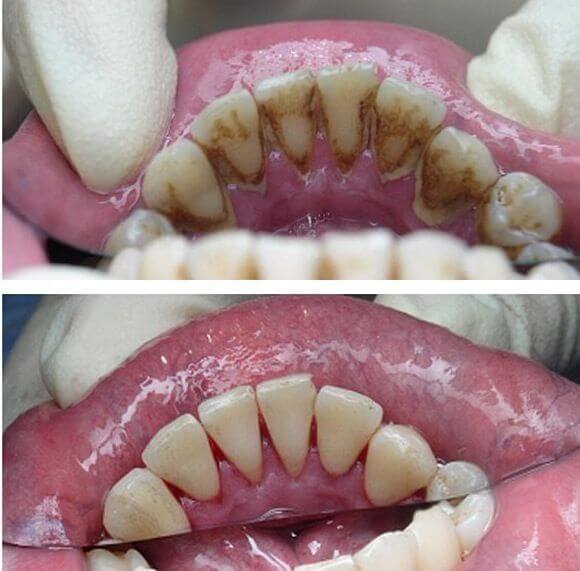 Anterior view before and after a hygiene cleaning: heavy tartar at top, clean enamel at bottom.