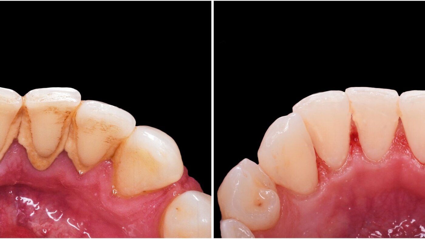 Close-up before and after a hygiene cleaning: tartar buildup and stains at the gumline on the left; a clean enamel surface and healthy gumline on the right.
