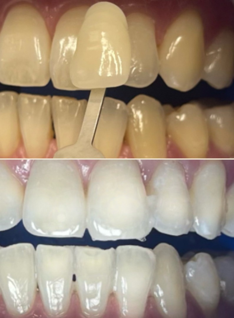 Before and after teeth whitening result